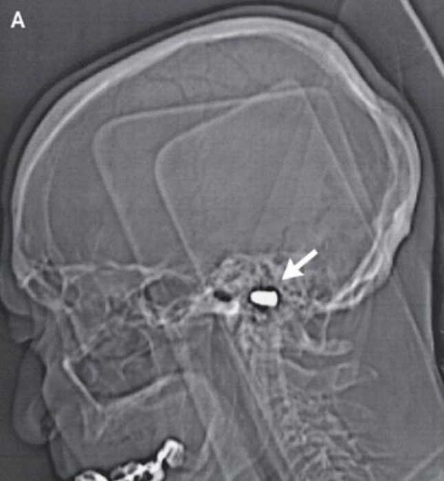Рентгеновский снимок раненного в голову мужчины. Фото с сайта nejm.org