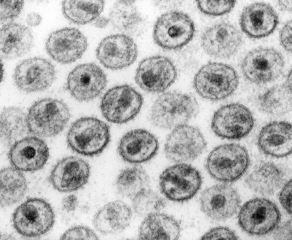 Вирус иммунодефицита человека. Фото из свободных источников.