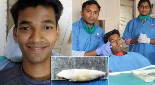 Подростку вырвали самый длинный зуб в мире