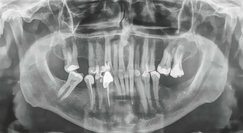 Рентгеновский снимок челюсти пациента, у которого удалили самый длинный в мире зуб. © Max Lukas