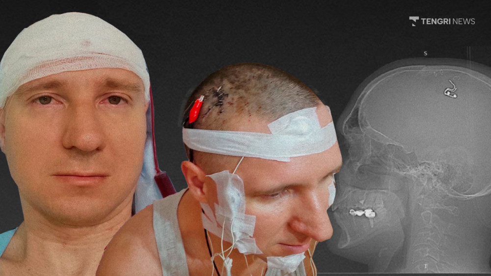 Что говорит россиянин, который просверлил себе череп в Алматы