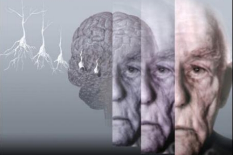 Ученые выяснили причину болезни Альцгеймера