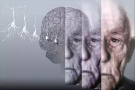 Ученые выяснили причину болезни Альцгеймера