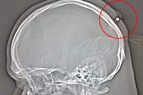 Поляк пять лет не знал о пуле в собственной голове