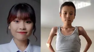 Один на миллион: 16-летняя казахстанка борется с редкой формой рака