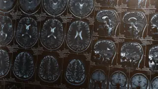 Деменция қаупін едәуір төмендететін қарапайым әдет аталды