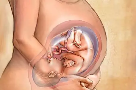 Ученые научились предотвращать выкидыш