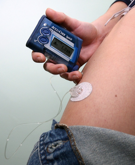 Инсулиновая помпа. Фото РИА Новости©