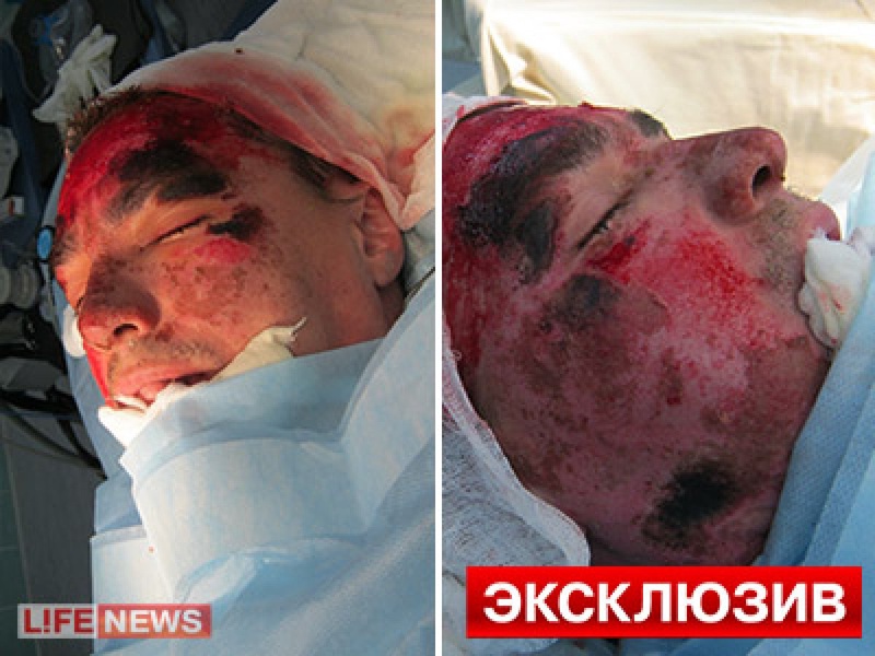 Хирурги аккуратно удаляли отмершие частицы кожи. Фото с сайта <a href="http://www.lifenews.ru" target="_blank">lifenews.ru</a>