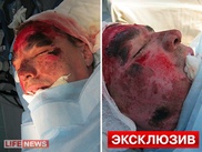 СМИ опубликовали фотографии с операций на лице балетмейстера из России 