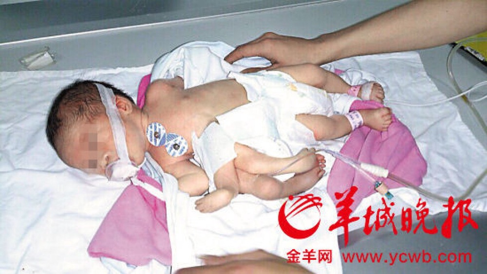 Малыш родился с восемью конечностями. Фото с сайта globaltimes.cn