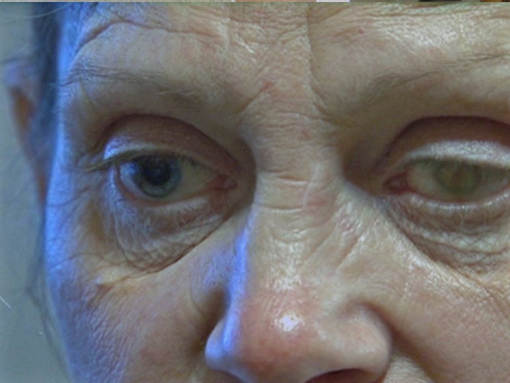 Глаза пострадавшей в результате операции жительницы Актобе. Фото © Жангуль Болатова