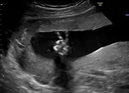 Малыш в животе показал родителям жест "победы"