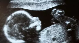 В утробе 92-летней чилийки обнаружили 50-летний плод