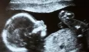 В утробе 92-летней чилийки обнаружили 50-летний плод