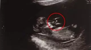 На снимке эмбриона нашли ангела-спасителя