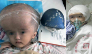 Китайские врачи пересадили череп 3-летней девочке