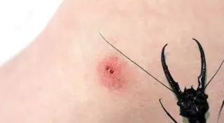 Мужчина умер от укуса насекомого в Жамбылской области