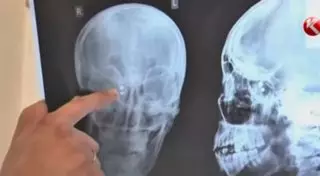 В Кентау собаколовы лишили глаза 23-летнюю девушку