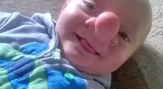 Врачи помогли мальчику-буратино