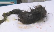 В Таразе хирурги нашли в желудке девочки больше килограмма волос