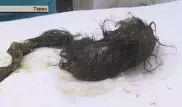В Таразе хирурги нашли в желудке девочки больше килограмма волос