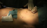 Женщина умерла после липосакции в частной клинике в Алматы
