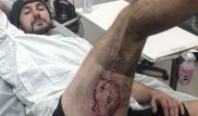 У велосипедиста взорвался iPhone 6 в кармане шорт