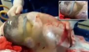 Врачи показали невероятно редкие кадры рождения ребенка в "рубашке"