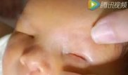 В Китае родился ребенок без глаз