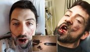 Взрыв электронной сигареты выбил американцу семь зубов