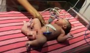 В Индии появилась на свет девочка с тремя ногами