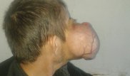 Состояние мужчины с жуткой шишкой на лице ухудшилось в Костанае, рассказала дочь