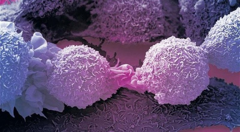 Раковые клетки. Фото: Wellcome Collection