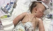 Дыра в трахее. Малыш проглотил батарейку и сжег внутренности