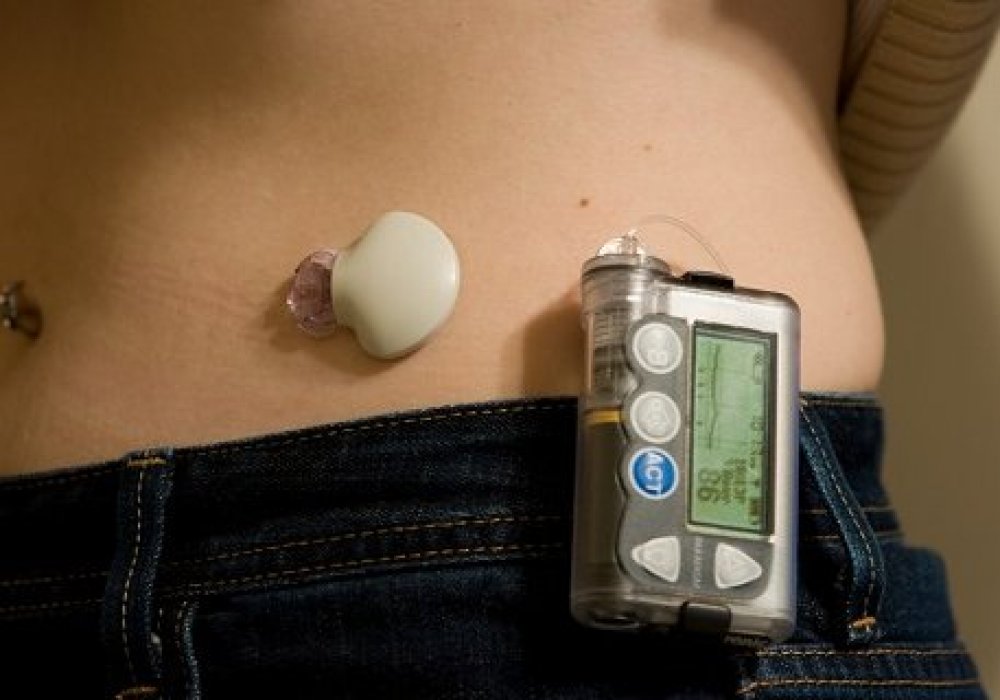 Инсулиновая помпа. Иллюстративное фото с сайта dabet-med.com
