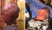 Обезображенному в пожаре малышу собрали всю сумму на операцию