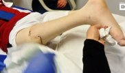 Врачи пришили ногу подростку задом наперед, чтобы он стал футболистом