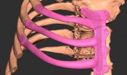 Пациенту напечатали грудную клетку на 3D-принтере в Британии