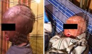 Бахтиерка: Обезображенный в пожаре малыш идет на поправку