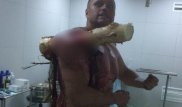 "Вспомните его, когда посадите занозу": продырявленный бревном насквозь белорус шокировал соцсети