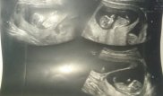 "Сразу троих граждан мы подарили государству" - 23-летняя роженица из Костаная