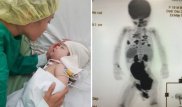 Больную раком Алиму Копей привезли на лечение в США