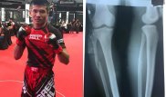 Казахстанский боец со сломанной ногой завоевал медаль чемпионата мира