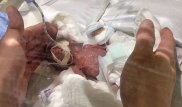 Новорожденного мальчика весом 268 граммов спасли японские врачи
