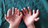 В Китае прооперировали девочку с 14 пальцами