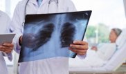Онколог қандай ауру түрлері өкпе қатерлі ісігіне әкеп соғатынын айтты