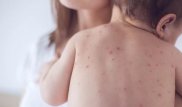 Казахстан упомянули среди стран, где много заболевших корью