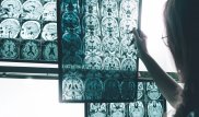 Ученые сделали прорыв в лечении болезни Альцгеймера