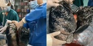 Хирурги показали, как выглядят легкие человека, курившего 30 лет